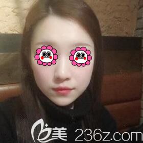 在长沙雅美打玻尿酸丰下巴术后21天效果 在长沙雅美打玻尿酸丰下巴术后21天效果