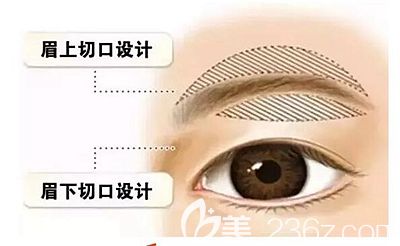 安阳苏莱美解析提眉手术的原理