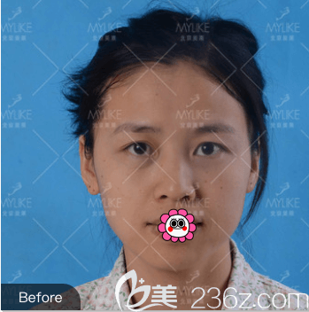 我在北京美莱做上睑提肌和双眼皮前样子 我在北京美莱做上睑提肌和双眼皮前样子