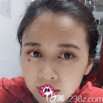 我在北京美莱做上睑提肌和双眼皮第30天效果 我在北京美莱做上睑提肌和双眼皮第30天效果
