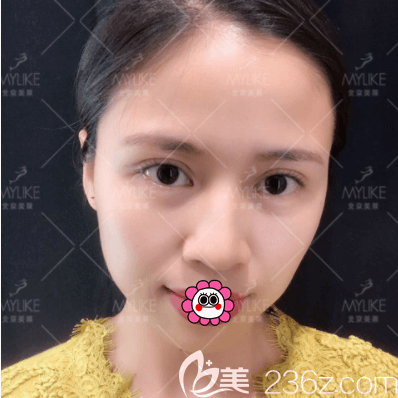 北京美莱上睑提肌+祛皮祛脂+双眼皮案例 北京美莱上睑提肌+祛皮祛脂+双眼皮案例