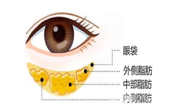 聚能美雕祛眼袋技术原理