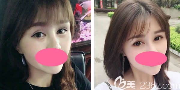 真人案例：29岁妹纸做聚能美雕祛眼袋术后一个月效果