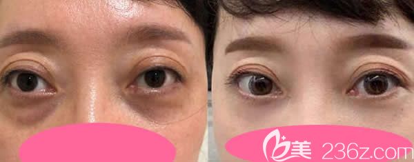真人案例：40岁大姐做聚能美雕祛眼袋二十八天效果