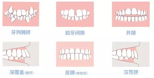 孔明星医生科普：什么时候给孩子矫正牙齿好呢