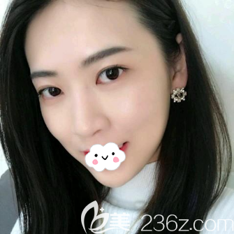 内江达芬奇面部线雕提升术后侧脸效果 内江达芬奇面部线雕提升术后侧脸效果