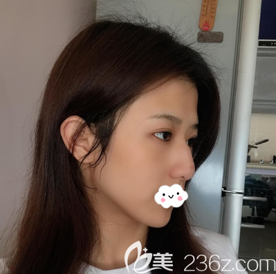 驼峰鼻矫正术前侧面照片 驼峰鼻矫正术前侧面照片