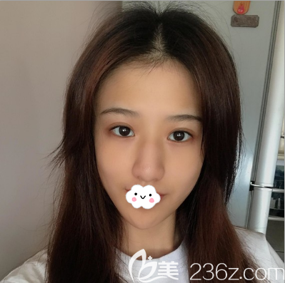 驼峰鼻矫正术前正面照片 驼峰鼻矫正术前正面照片