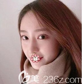 韦小勇鼻综合术后84天