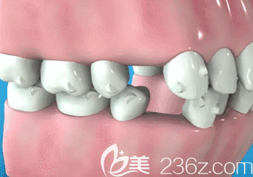 张漫医生科普：正畸两年了牙缝还没关上，是矫正失败吗