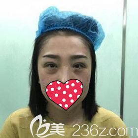 在名流做双眼皮修复术后即刻效果照片 在名流做双眼皮修复术后即刻效果照片