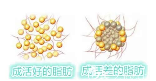 脂肪填充后热敷不利于脂肪细胞成活