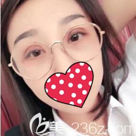 在沈阳名流修复双眼皮术后20天效果照 在沈阳名流修复双眼皮术后20天效果照