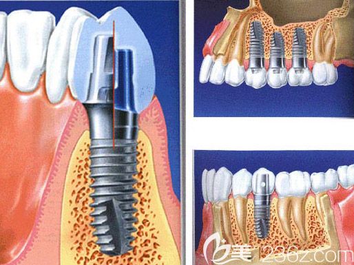 北京维嘉口腔任毅医生介绍微创种植牙技术 北京维嘉口腔任毅医生介绍微创种植牙技术
