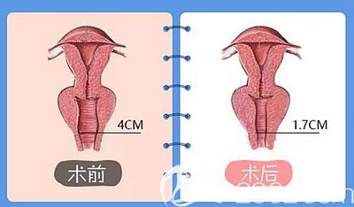 洛阳华美阴道紧缩手术原理