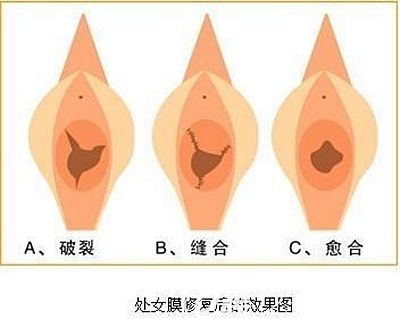 洛阳华美处女膜修复手术原理