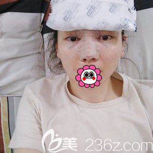 宁波静港林忠泵做鼻综合术后即刻 宁波静港林忠泵做鼻综合术后即刻