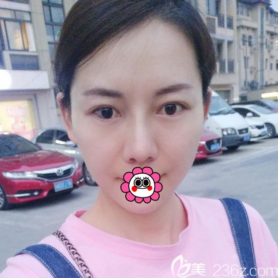 鼻综合术后10天恢复效果 鼻综合术后10天恢复效果