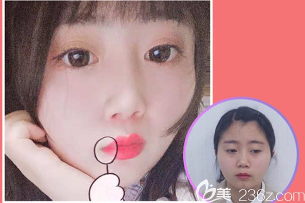 呼和浩特五洲王焕鼻综合隆鼻案例效果图