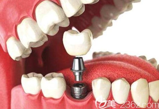 如何判断种植牙是否成功？贝口腔种植医生陈桦介绍