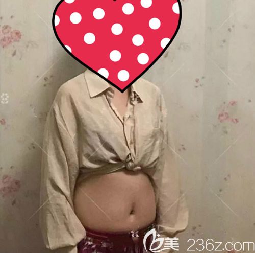 我找赣州薇琳钟林辉做腰腹环吸术前 我找赣州薇琳钟林辉做腰腹环吸术前