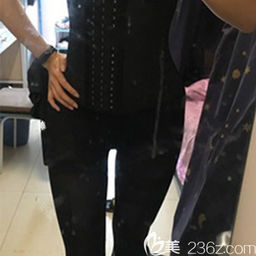 我找赣州薇琳钟林辉做腰腹环吸术后第10天 我找赣州薇琳钟林辉做腰腹环吸术后第10天