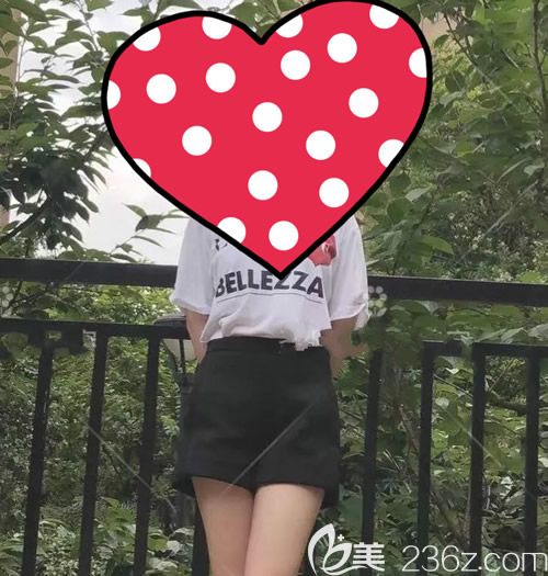 我找赣州薇琳钟林辉做腰腹环吸术后60天效果 我找赣州薇琳钟林辉做腰腹环吸术后60天效果