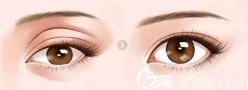 眼窝凹陷填充手术对比图 眼窝凹陷填充手术对比图