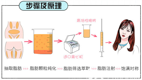 眼窝凹陷填充手术原理图 眼窝凹陷填充手术原理图
