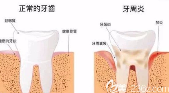 徐涛医生来告诉大家:牙周炎是不是必须要拔牙 徐涛医生来告诉大家:牙周炎是不是必须要拔牙