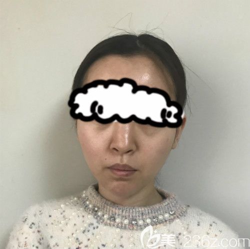 在赣州薇琳医疗美容成功做了隆鼻失败修复手术前的我 在赣州薇琳医疗美容成功做了隆鼻失败修复手术前的我