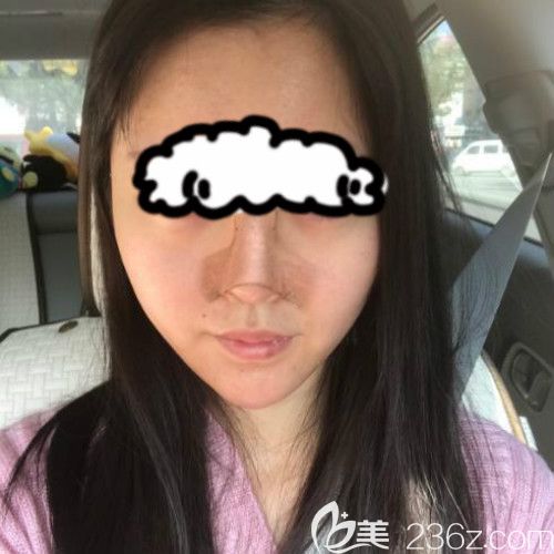 在赣州薇琳医疗美容成功做了隆鼻失败修复手术后第4天 在赣州薇琳医疗美容成功做了隆鼻失败修复手术后第4天