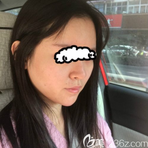 在赣州薇琳医疗美容成功做了隆鼻失败修复手术第15天 在赣州薇琳医疗美容成功做了隆鼻失败修复手术第15天