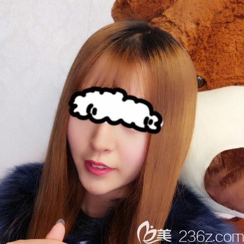 在赣州薇琳医疗美容成功做了隆鼻失败修复手术第40天 在赣州薇琳医疗美容成功做了隆鼻失败修复手术第40天