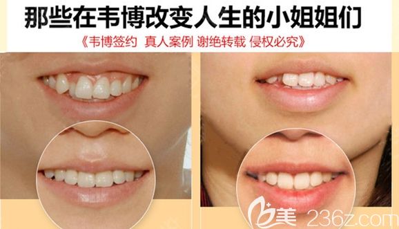 深圳韦博口腔牙齿矫正案例效果图 深圳韦博口腔牙齿矫正案例效果图