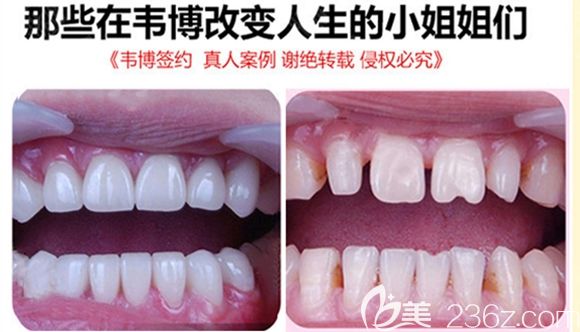深圳韦博口腔牙齿贴面效果图 深圳韦博口腔牙齿贴面效果图