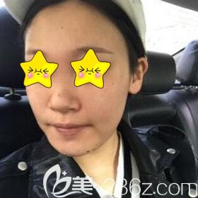 做鼻综合面部脂肪填充术前照 做鼻综合面部脂肪填充术前照