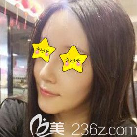 在爱德丽格做鼻综合脂肪填充面部术后半个月恢复效果 在爱德丽格做鼻综合脂肪填充面部术后半个月恢复效果