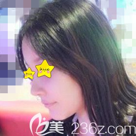 在大连做鼻整形+自体脂肪填充面部术后20天时的效果照 在大连做鼻整形+自体脂肪填充面部术后20天时的效果照