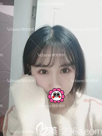 双眼皮术后恢复一个月效果