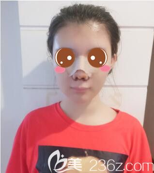 <!--<i data=20240703-sp></i>-->华美谢卫国假体隆鼻真人案例术后第7天