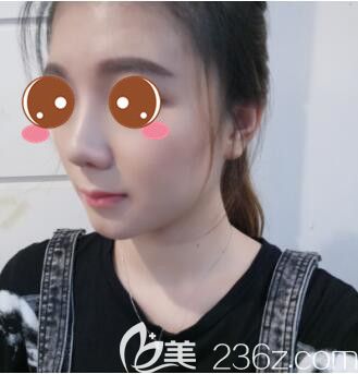 <!--<i data=20240703-sp></i>-->华美谢卫国假体隆鼻真人案例术后21天