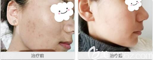 彭静医生做彩光祛斑术前术后对比 彭静医生做彩光祛斑术前术后对比