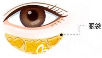 眼袋