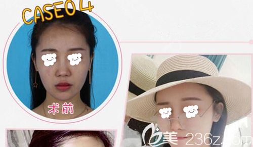 马永奎做真人案例术后3月面部饱满 马永奎做真人案例术后3月面部饱满