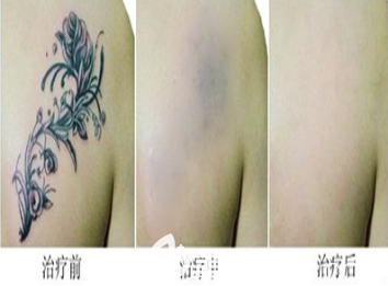 纹绣术前和术后的图片