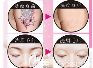 激光洗眉和洗纹身对比照