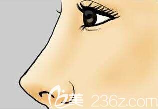 隆鼻材料假体如何选? 隆鼻材料假体如何选?