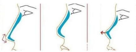 隆鼻材料硅胶和膨体那个更好 隆鼻材料硅胶和膨体那个更好