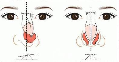 硅胶和膨体那个隆鼻材料能够更好一点 硅胶和膨体那个隆鼻材料能够更好一点